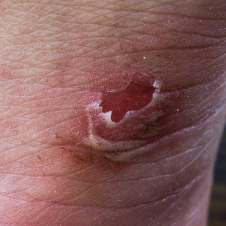 Scheuerstelle an den Füßen