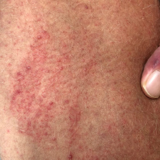 Scheuerstelle am Oberschenkel