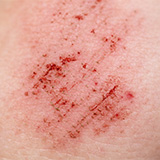 Scheuerstelle am Oberarm