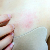 Scheuerstelle durch BH